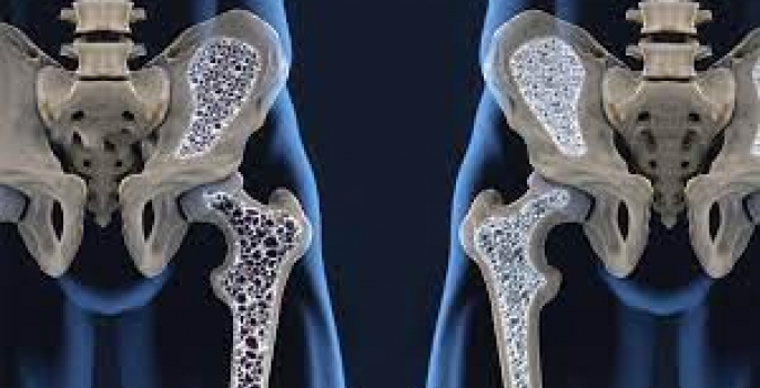 Osteoporose: problema de saúde pública