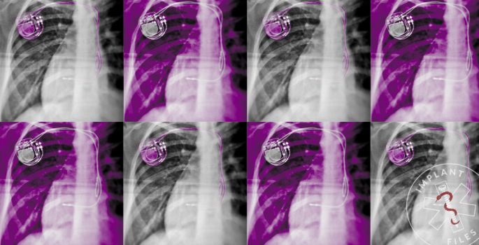 Anais da saúde pública: O cartel de implantes