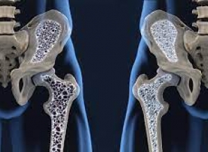 Osteoporose: problema de saúde pública