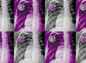Anais da saúde pública: O cartel de implantes
