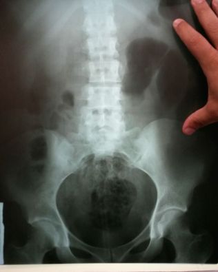 Visita é flagrada tentando entrar com droga no CDP de Cerqueira César